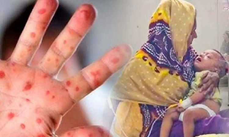 ২৪ ঘণ্টায় হামের উপসর্গে আরও ৪ শিশুর মৃত্যু, মোট মৃত ৭১২