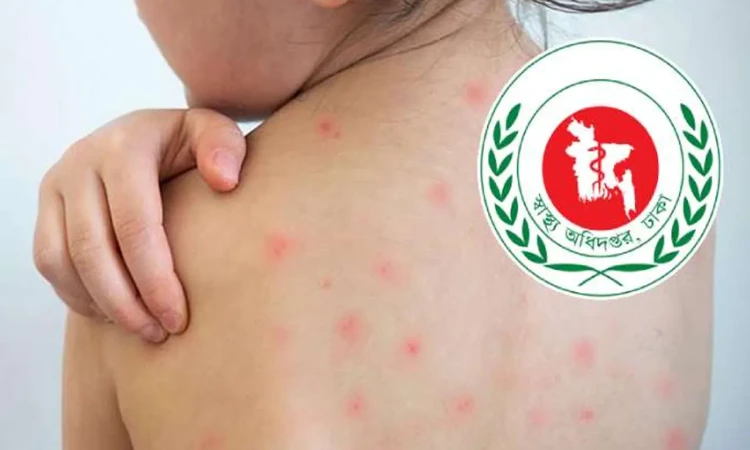 হামের উপসর্গে আরও ৪ শিশুর মৃত্যু, আক্রান্ত ১১৬০